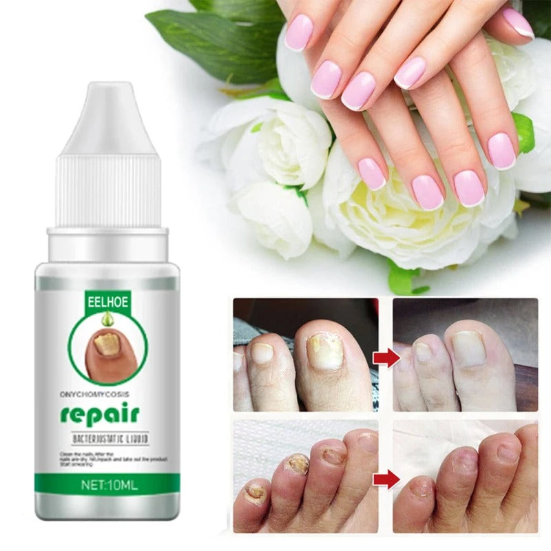 Suai Repair Compre 1 Leve 2 - Anti Fungos e Micoses Para Sua Unhas