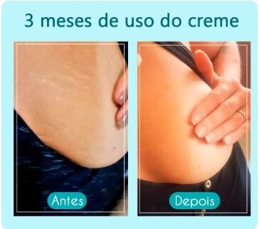 Creme Cicatribem Anti Estrias + Brinde Exclusivo - Frete Grátis Apenas Hoje