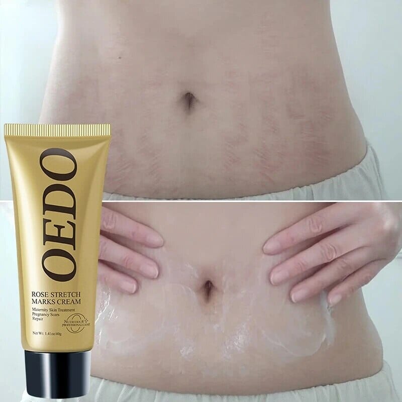 Creme Redutor De Estrias e Manchas - OEDO + Brinde - Oferta Somente Hoje