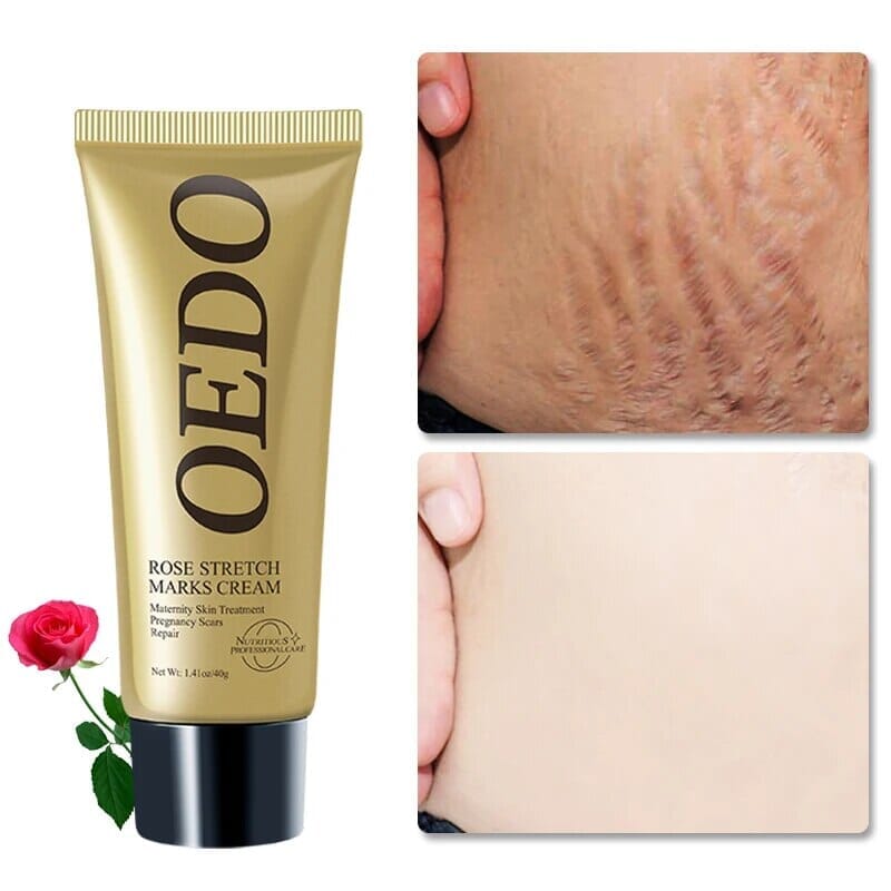 Creme Redutor De Estrias e Manchas - OEDO + Brinde - Oferta Somente Hoje