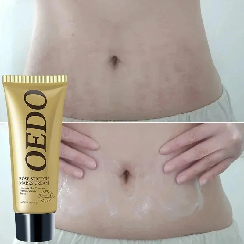 Creme Redutor De Estrias Para Gestantes - OEDO + Brinde