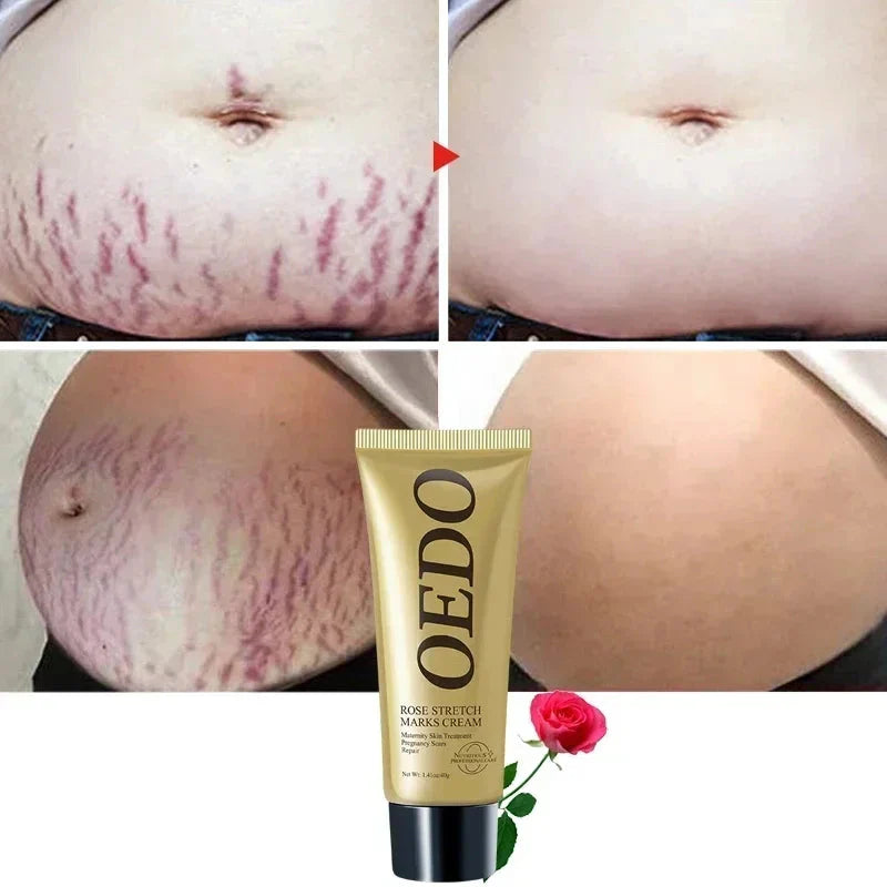 Creme Redutor De Estrias Para Gestantes - OEDO + Brinde