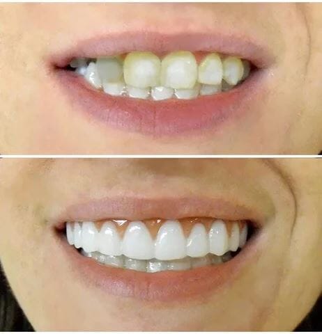 Compre 1 Leve 2 - Dentadura Universal NewSmile + Brinde - Oferta Somente Hoje