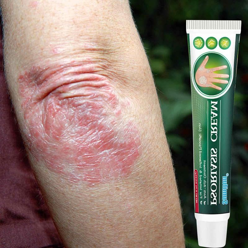 Pomada Para Psoríase Instantânea - Psoriasis Cream + Brinde - Site Oficial De Vendas