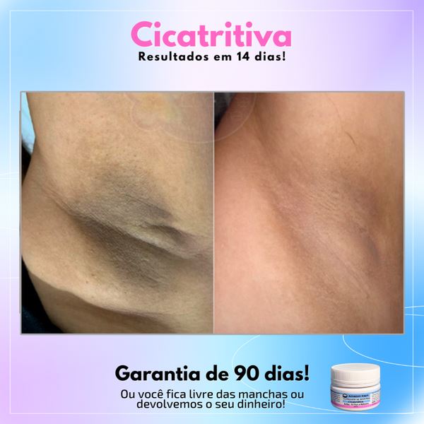 Promoção Compre 1 Leve 2 - Cicatridiva - Clareador de Manchas: Sua Jornada para uma Pele sem manchas