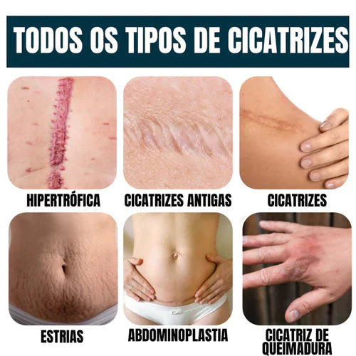 ScarAway® - Gel Cicatrizante 100% Avançado + Brinde - Site Oficial De Vendas